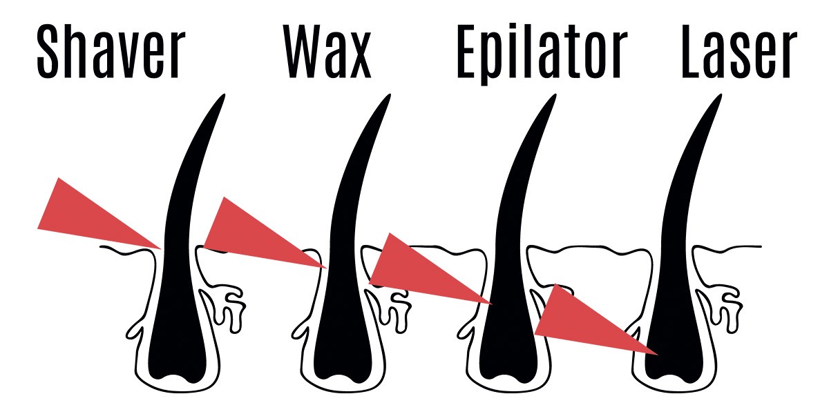 A diagram of the removal depth of the hair to different techniques